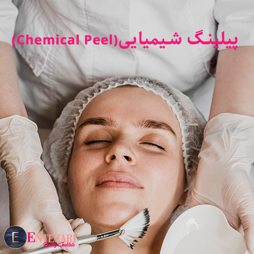 پیلینگ شیمیایی (Chemical Peel)